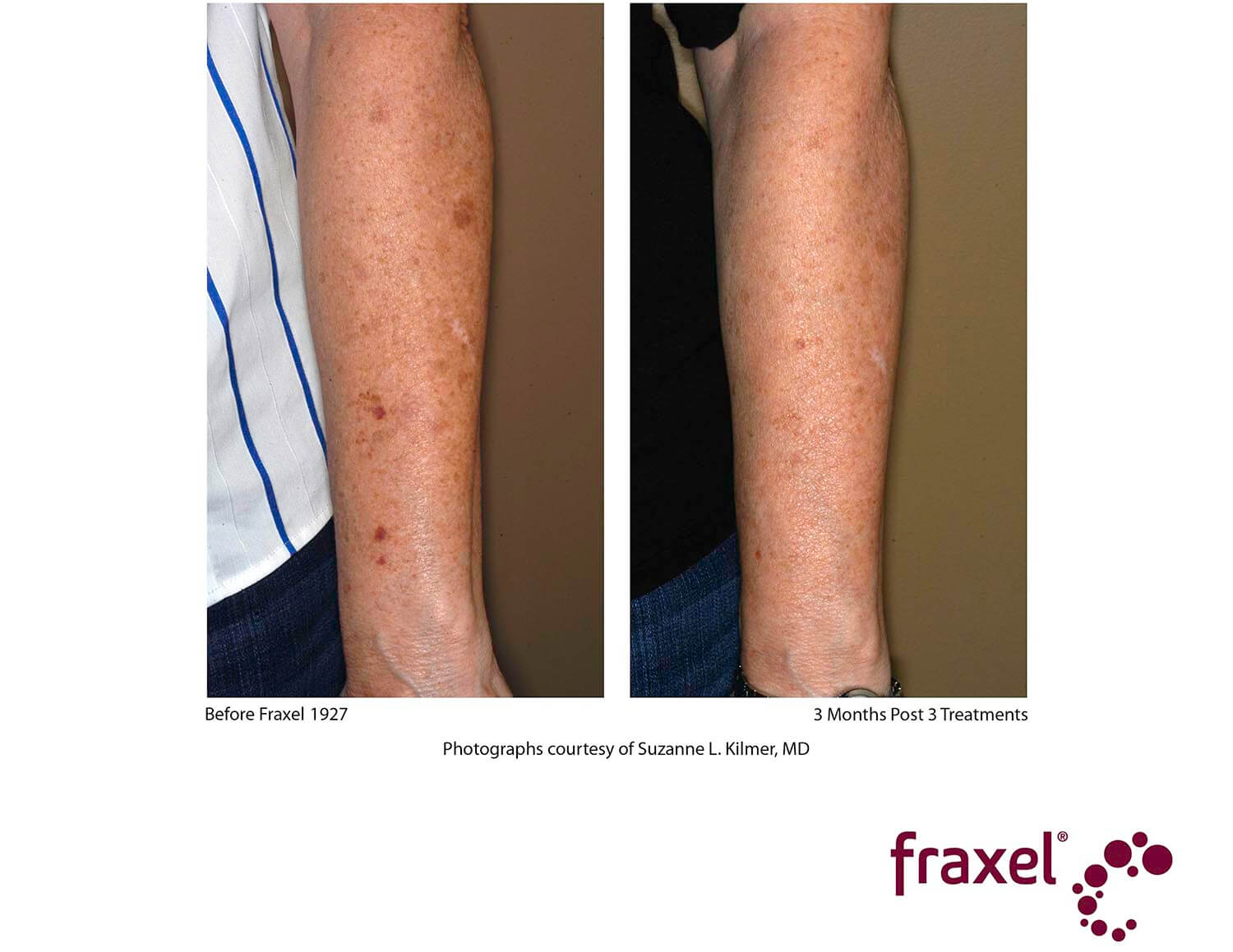 before-after-fraxel-1