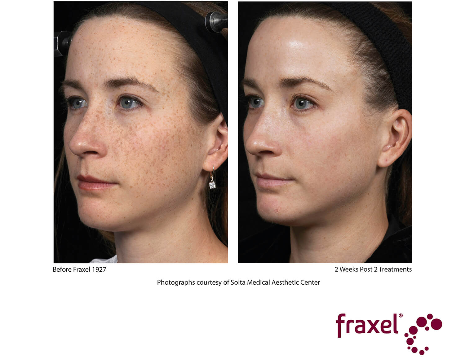 before-after-fraxel-2