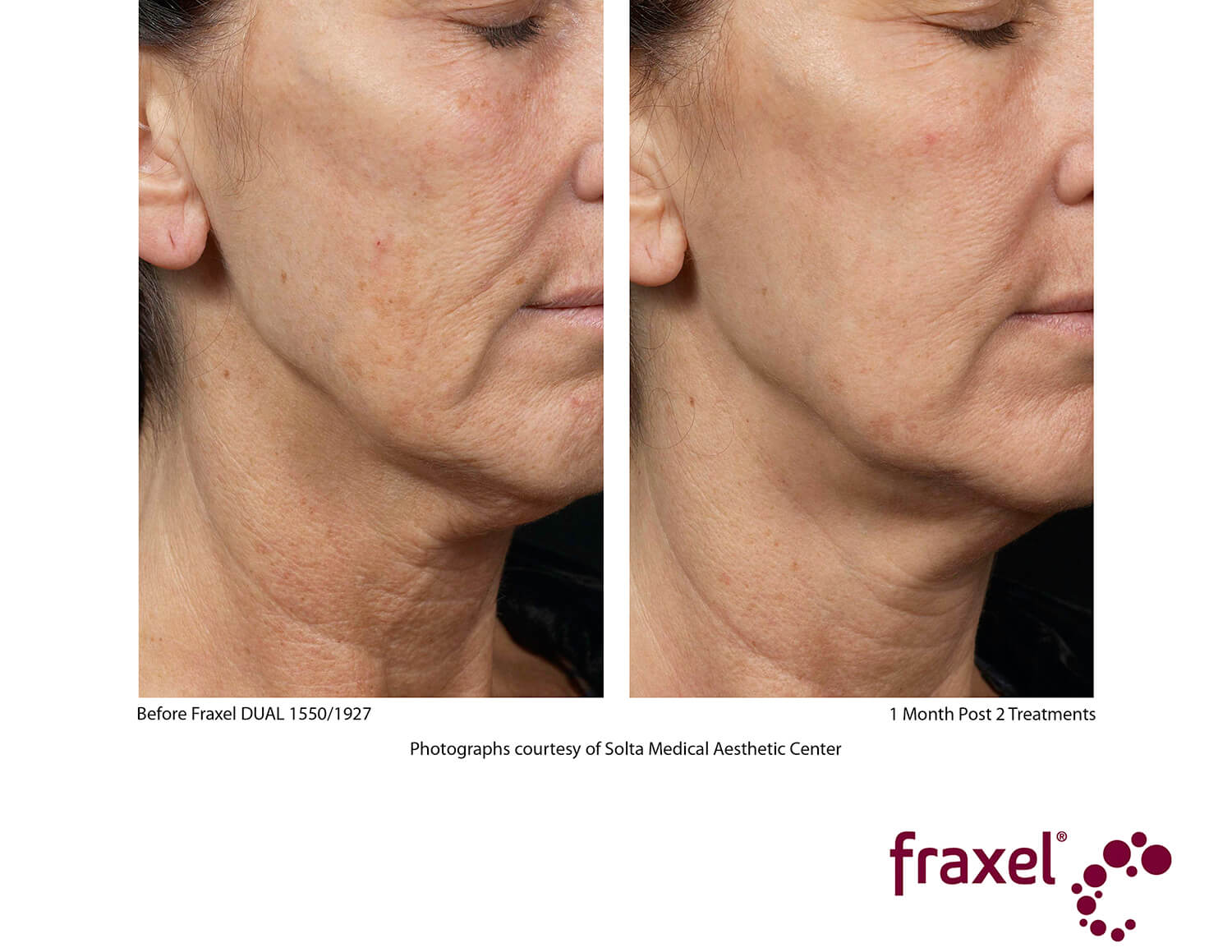 before-after-fraxel-3