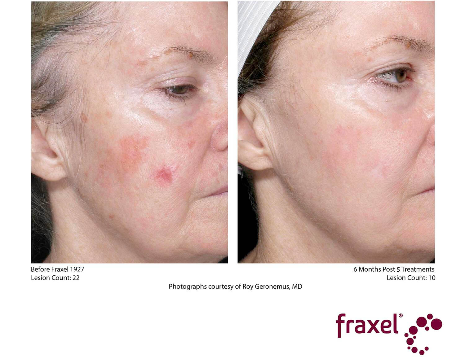 before-after-fraxel-4
