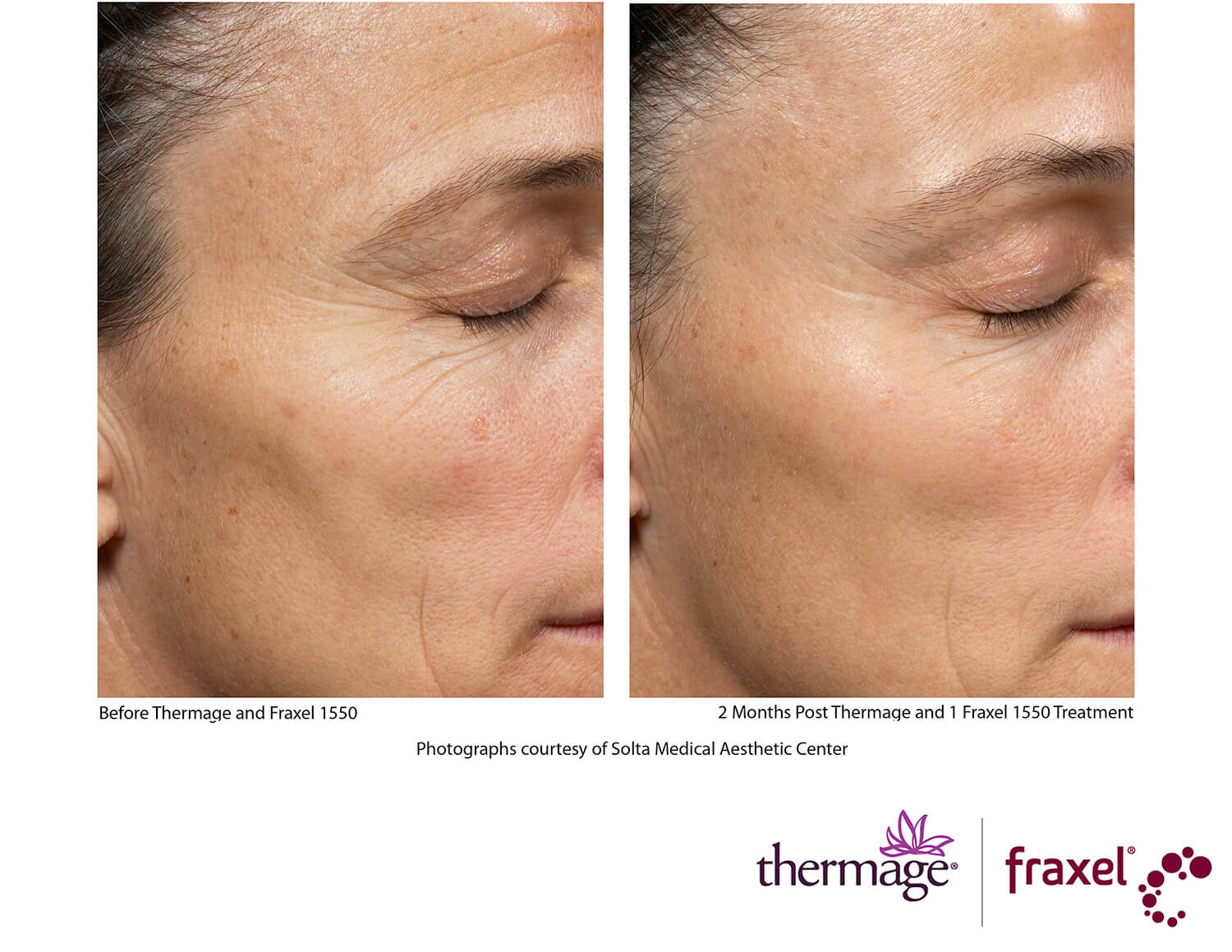 before-after-thermage-1