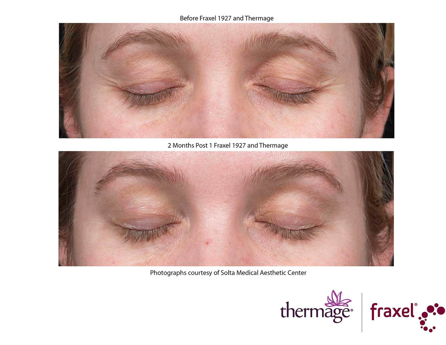 before-after-thermage-10