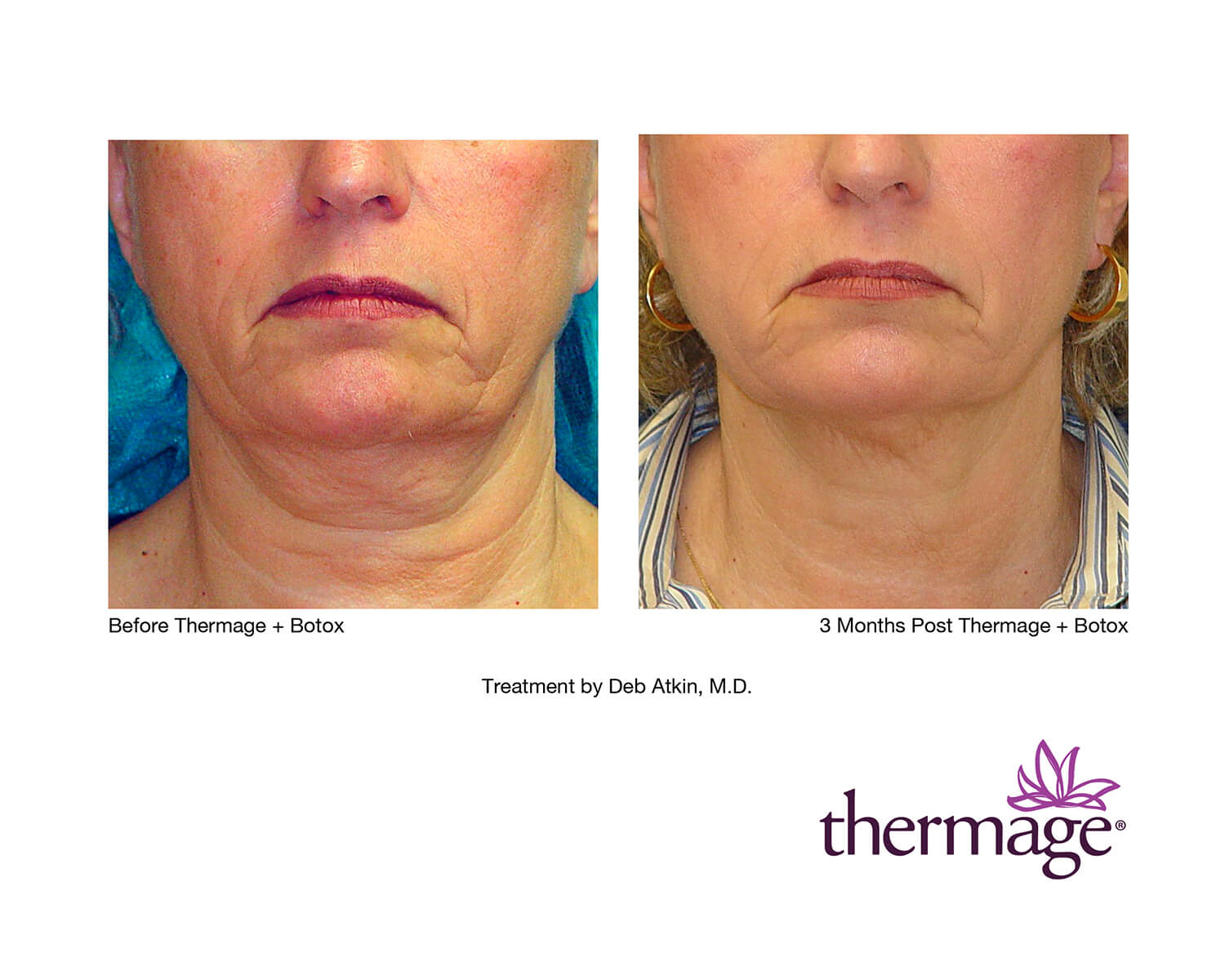 before-after-thermage-11
