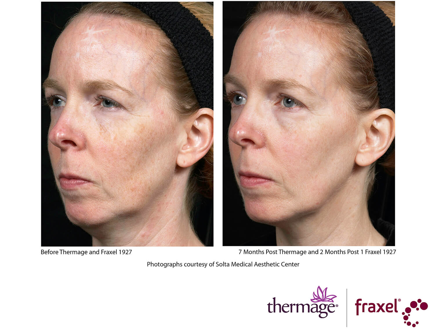 before-after-thermage-2