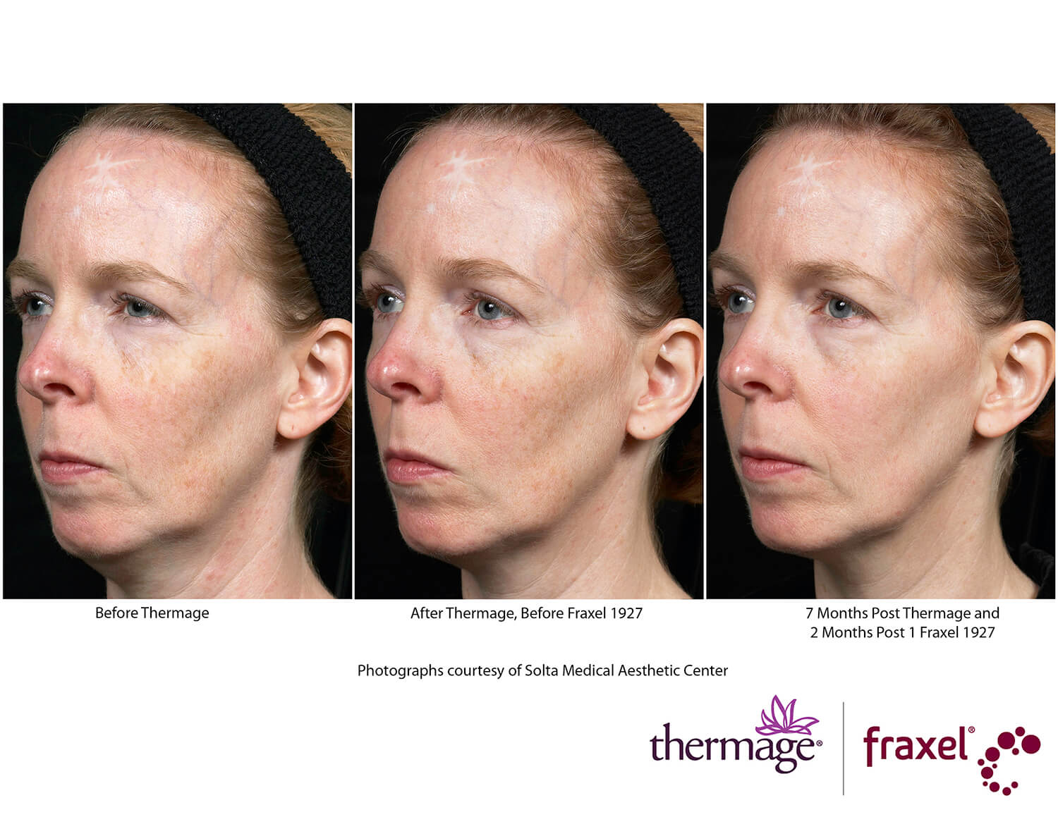 before-after-thermage-3