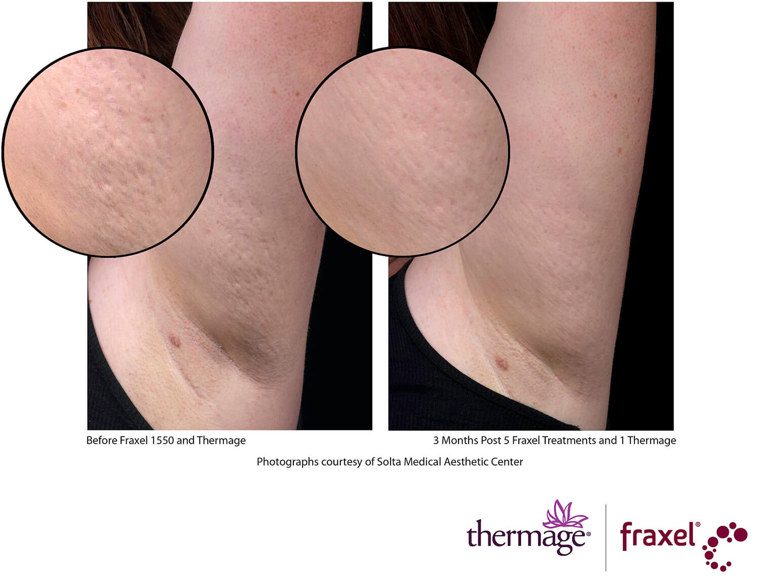 before-after-thermage-4