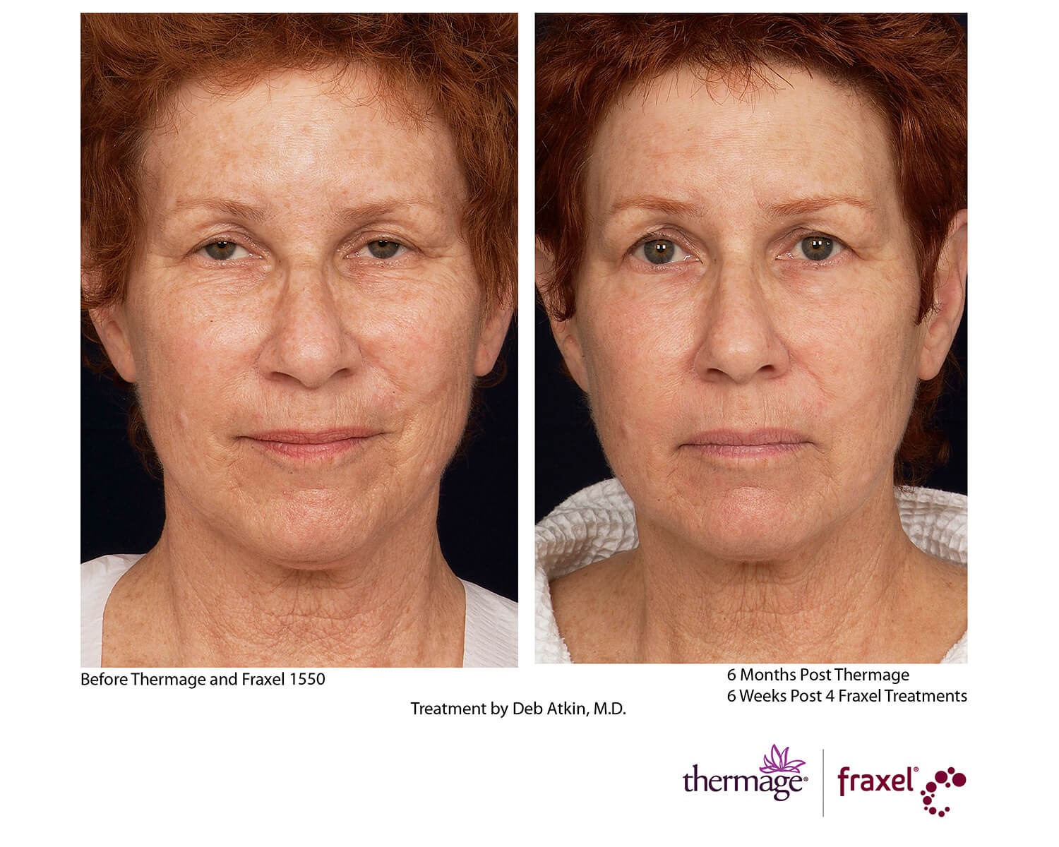 before-after-thermage-6