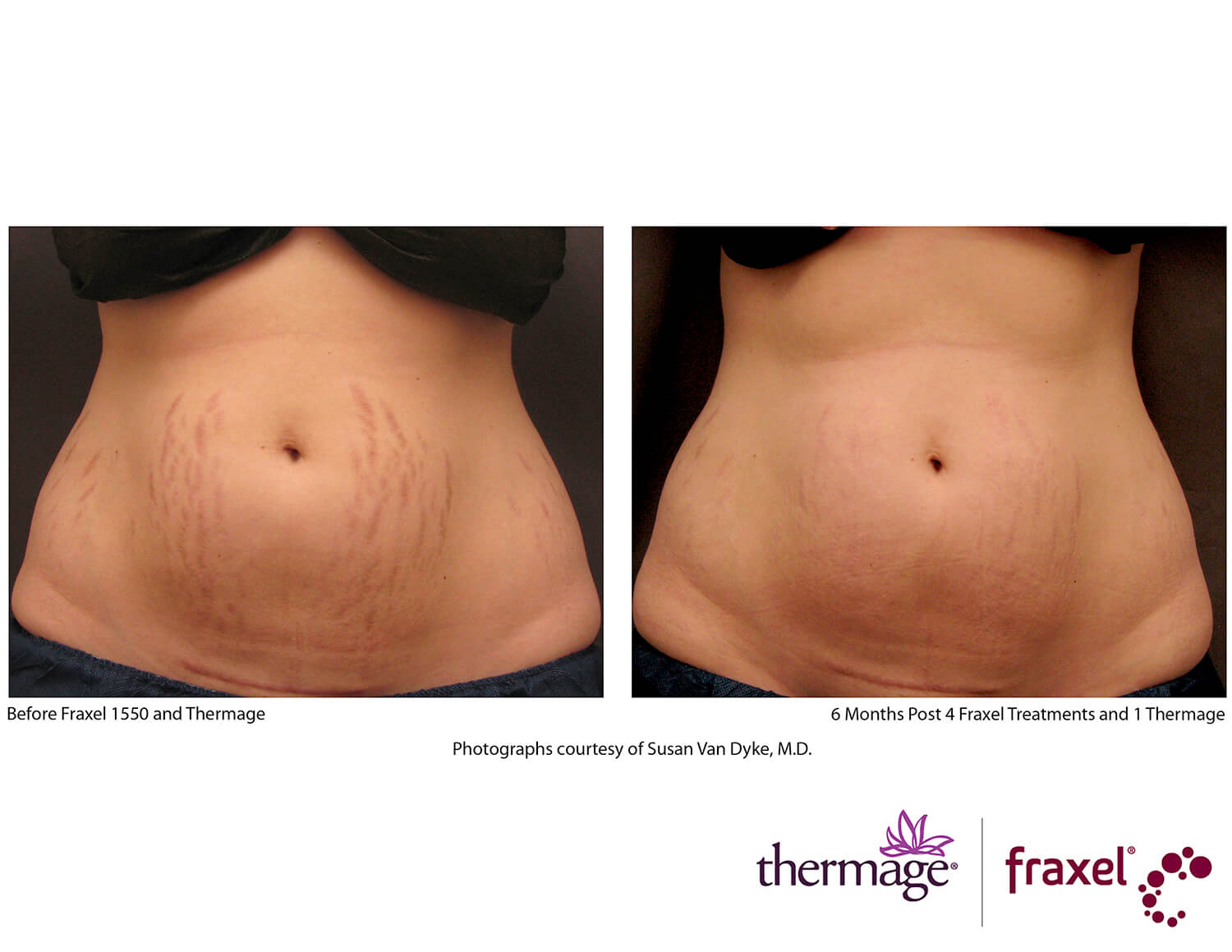 before-after-thermage-8