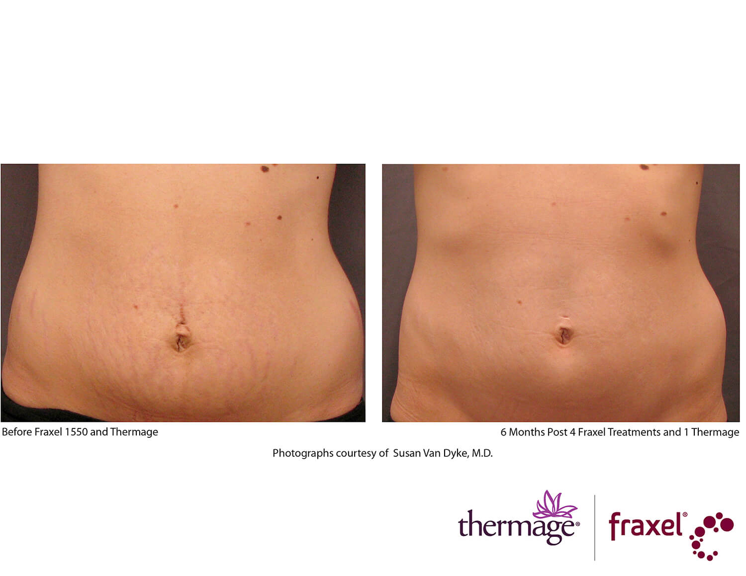 before-after-thermage-9